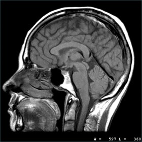 brain scan mri